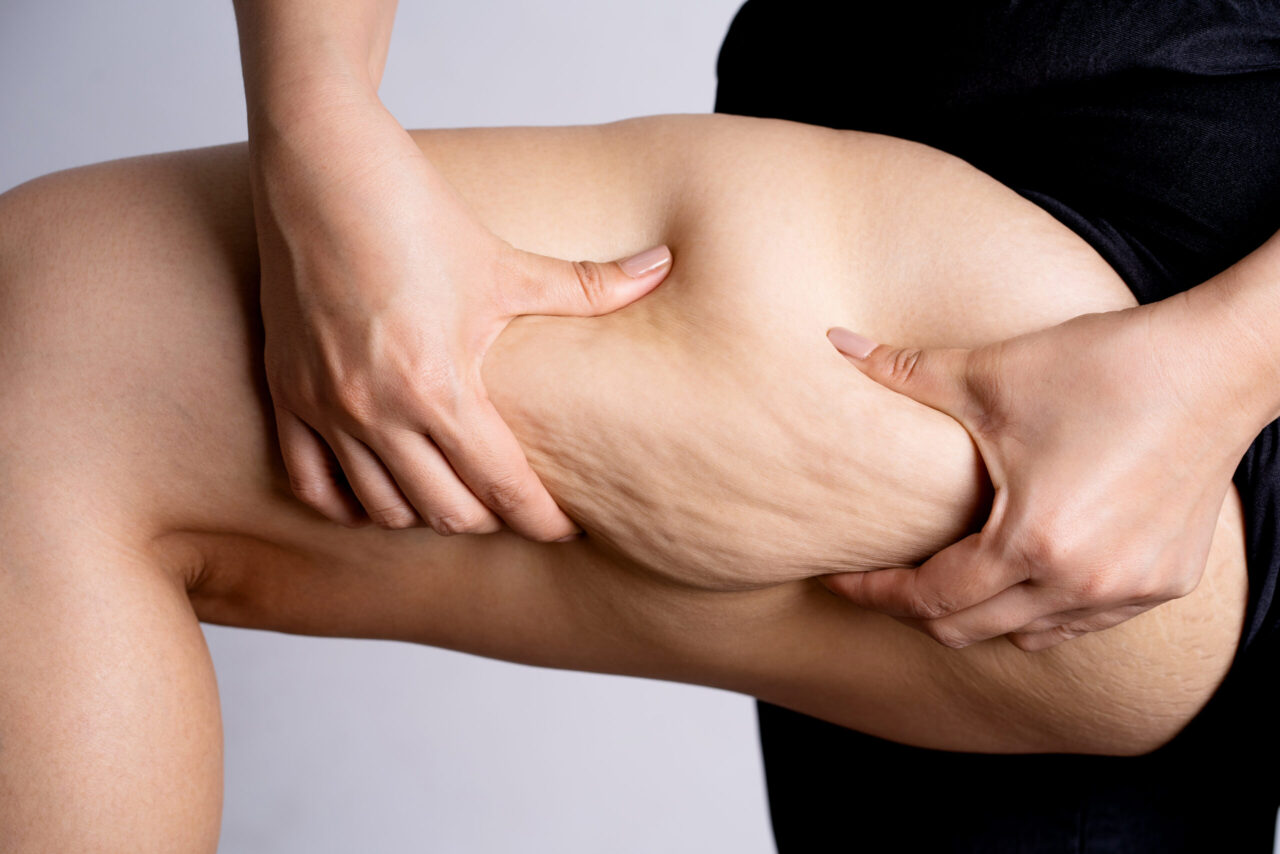 Lipedema Integrate Protocol